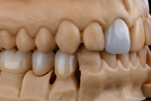 Digital Dental CAD Design Workflow on Exocad Software
