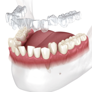 Advantages and disadvantages of Invisalign treatment