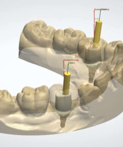 Custom Implant Abutment Design Service (Titanium / Hybrid)