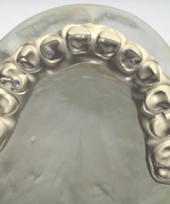 Digital All-on-X Implant Bridge Design with Thimble Bar Structure on Exocad