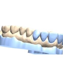 Digital Bleaching Tray Model Design with Gel Reservoirs and Block-out