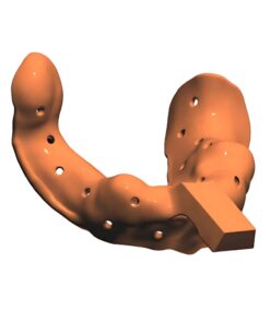 Digital Custom Impression Tray Design with Handle and Implant Holes