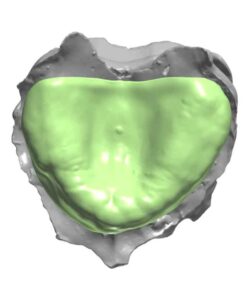 Digital RPD Framework Design Cast Partial Denture on Exocad