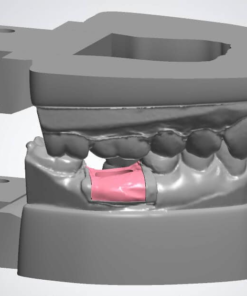 Digital Implant Model Design with Removable Soft Tissue Mask and Analog Holes