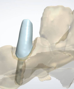 Digital Post and Core Design for Multi-Rooted Tooth with Split Key