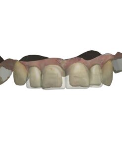 Digital Snap-on Smile Design Removable Veneers on Exocad