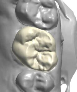 Temporary Crown & Bridge Model designed with CAD