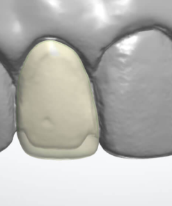 Digital Veneer Design Service (Esthetic Anterior)
